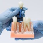 Wizualizacja montażu implantu